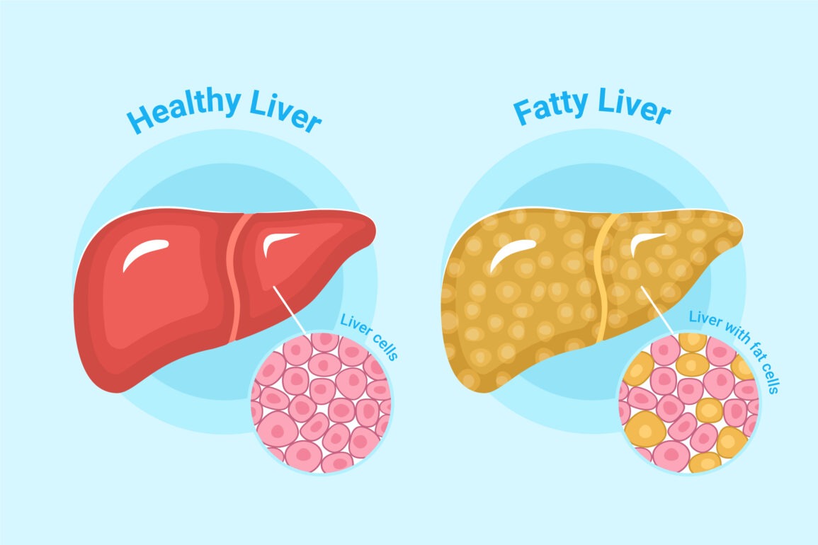 Fatty Liver