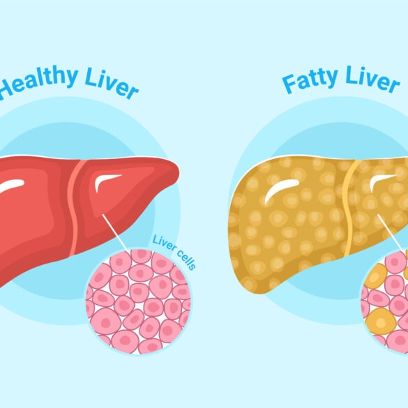 Fatty Liver