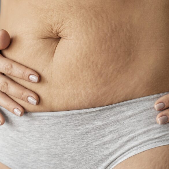 stretch marks in women