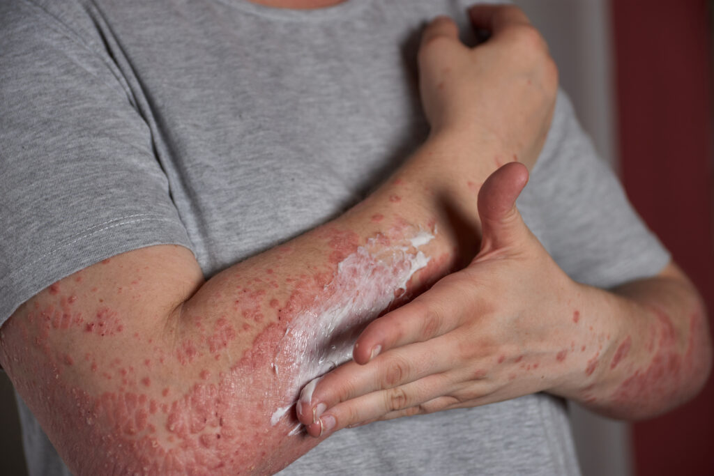 <a href="https://www.freepik.com/free-photo/applying-moisturizer-skin-with-psoriasis_29505750.htm#fromView=search&page=1&position=1&uuid=48bc0e13-00f5-416a-b41f-84f6559cc44b&query=Allergic+Contact+Dermatitis">Image by wirestock on Freepik</a>
