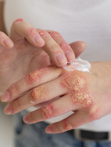 Allergic Contact Dermatitis