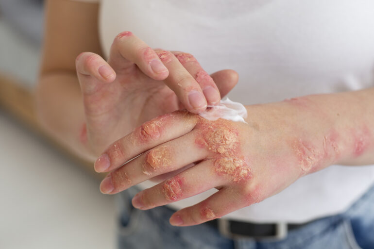 Allergic Contact Dermatitis