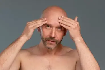Alopecia Areata