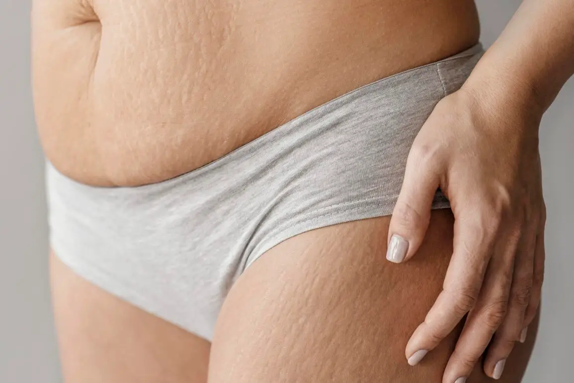Striae Rubrae in women