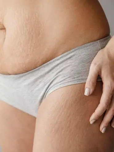 Striae Rubrae in women