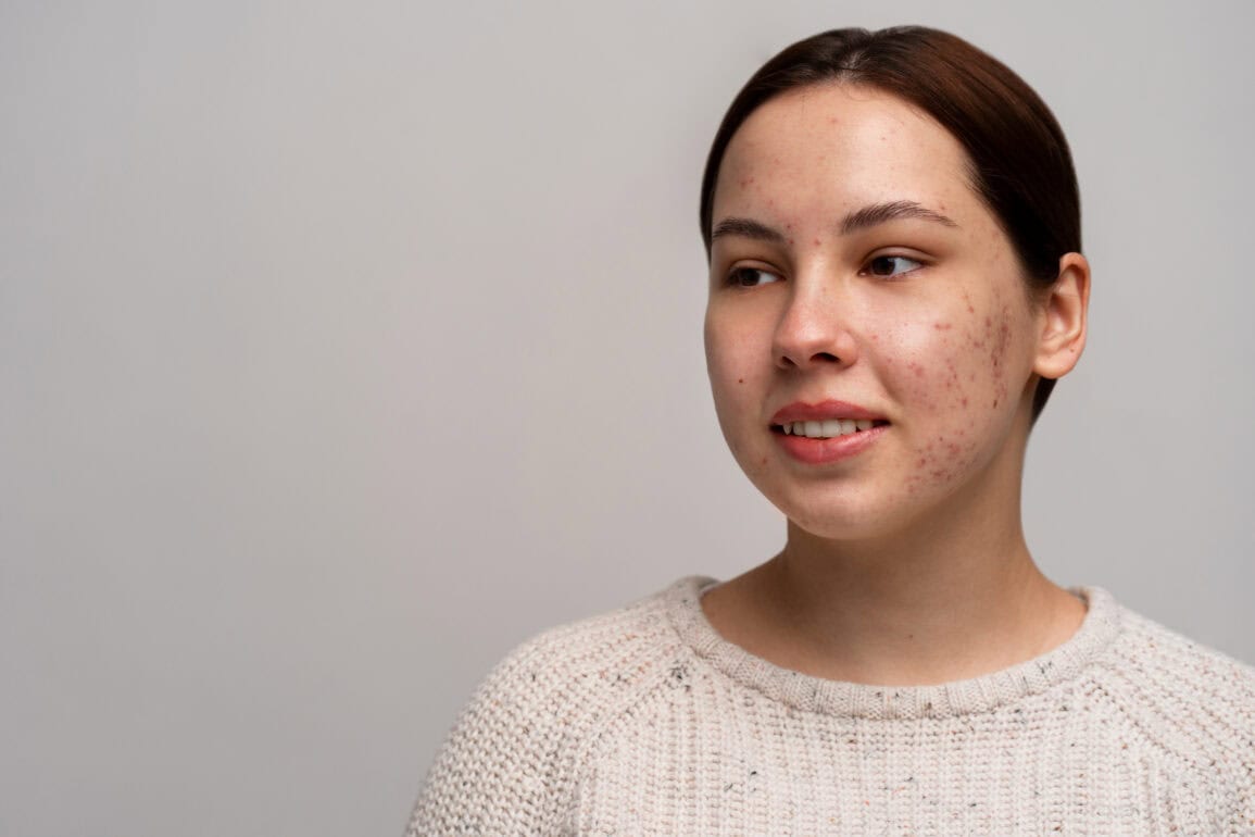 Rosacea