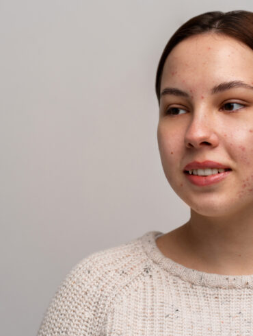 Rosacea