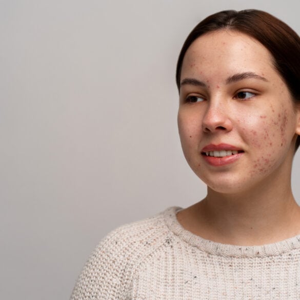 Rosacea