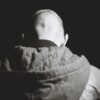 Alopecia Areata