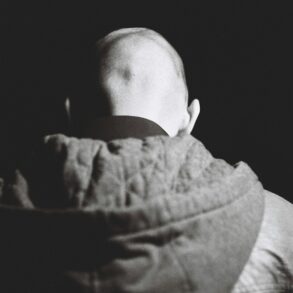 Alopecia Areata
