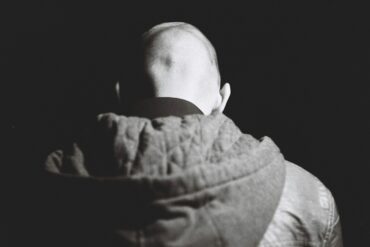 Alopecia Areata