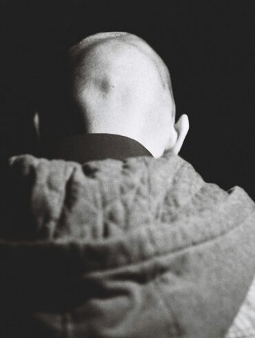 Alopecia Areata