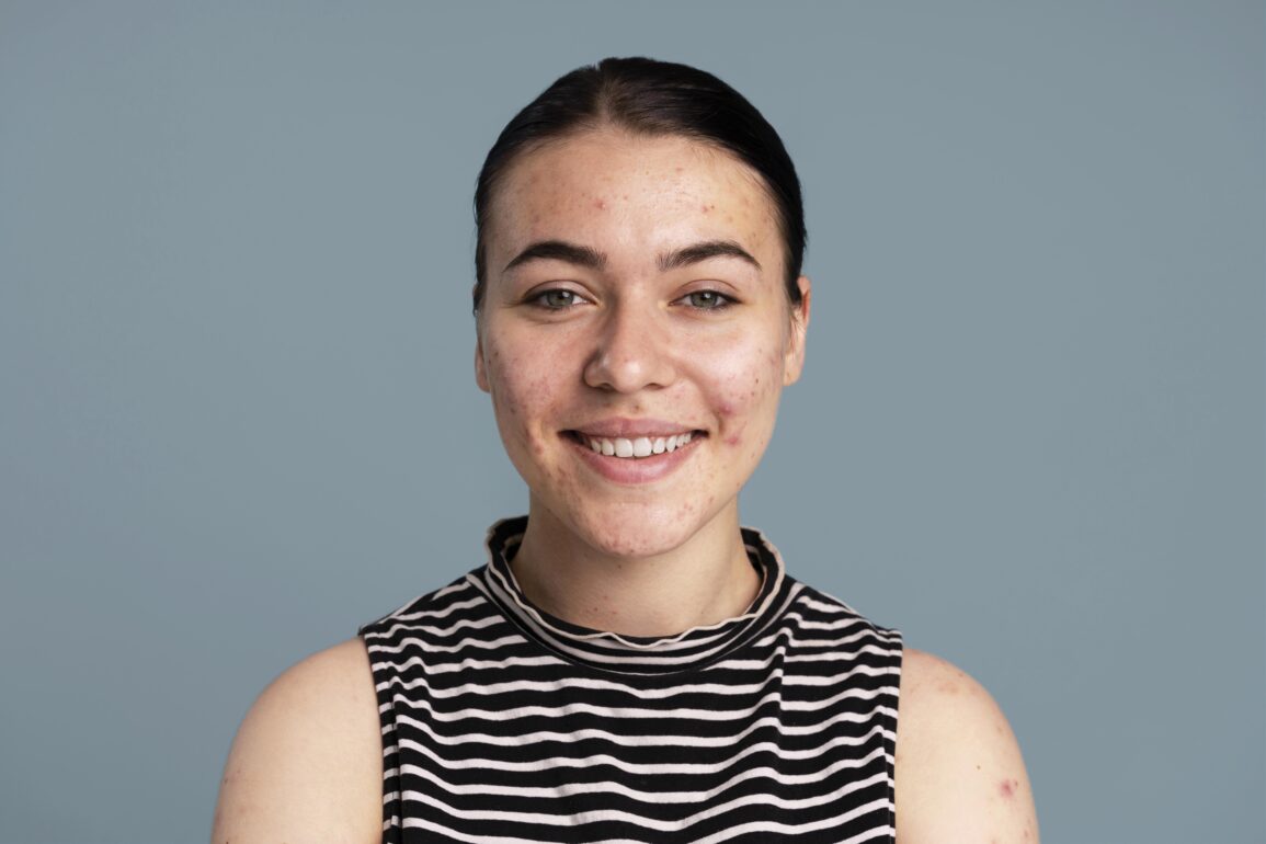 acne scars