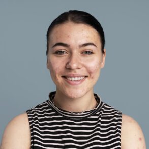 acne scars