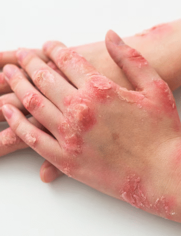 Can Ayurveda Cure Eczema? What Studies Say?